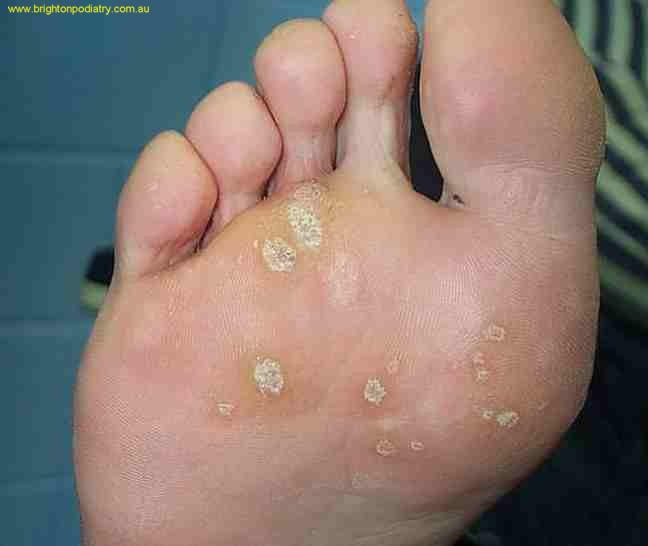 Planters Wart Heel