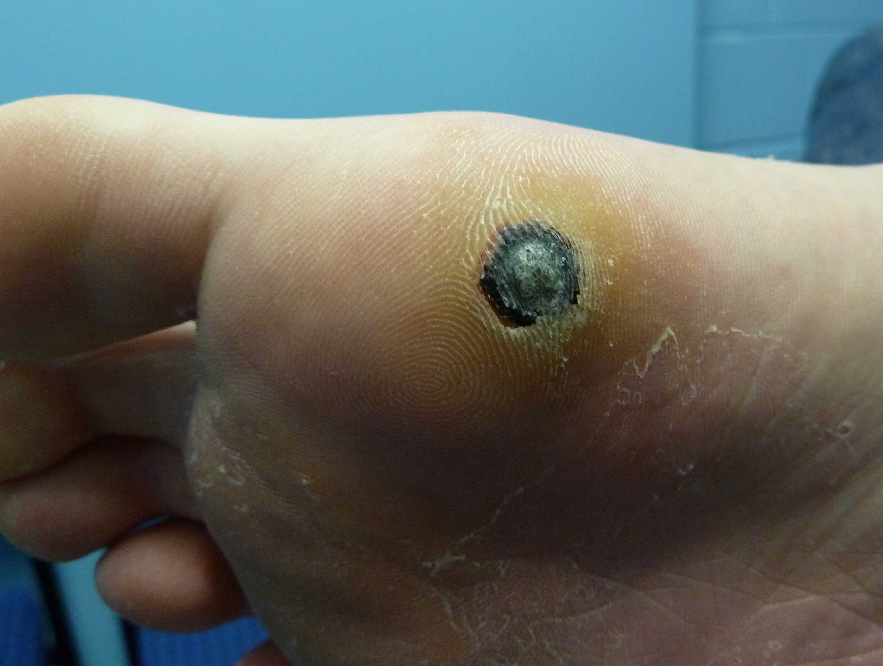 Plantar Warts Brightonpodiatry au