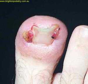 ingrown toenail