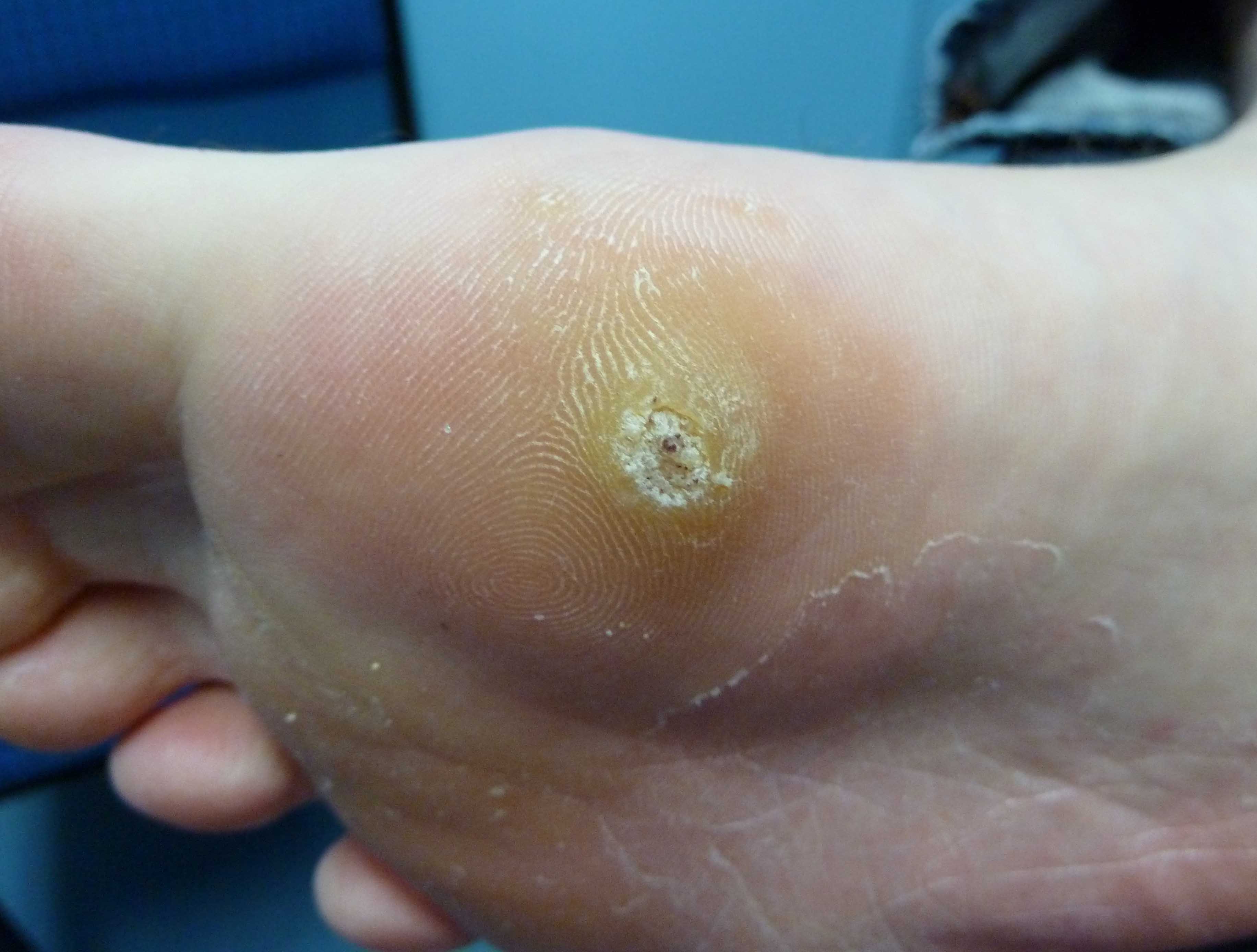 Plantar Warts Brightonpodiatry au