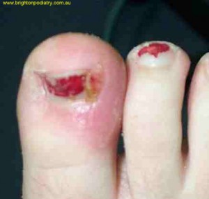 Ingrown Toenail 1