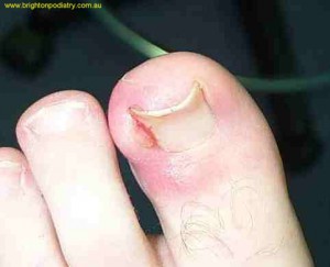 Ingrown Toenail 3